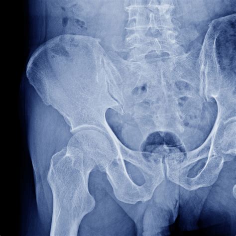 Four Reasons You May Require A Hip Replacement Houston Scoliosis