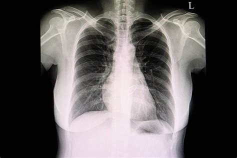 Chest Ray Film Patient Cardiomegaly Left Pleural Effusion Cephalization