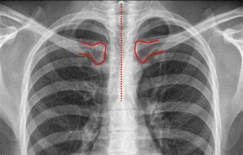 Rx De T Rax Postero Anterior Qu Es S Ntomas Y Tratamiento Top Doctors