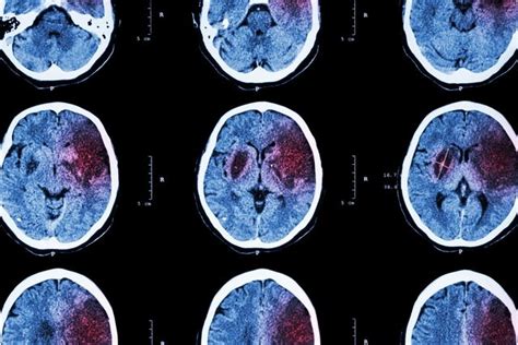 Hemorragia cerebral sintomas causas tratamento e consequências Tua