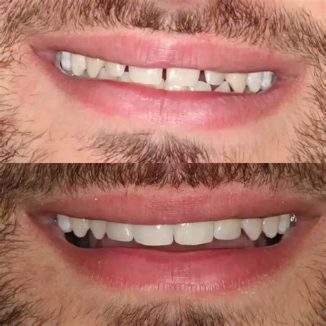 Porcelain Veneers Cost Sydney Factors That Affect Pricing