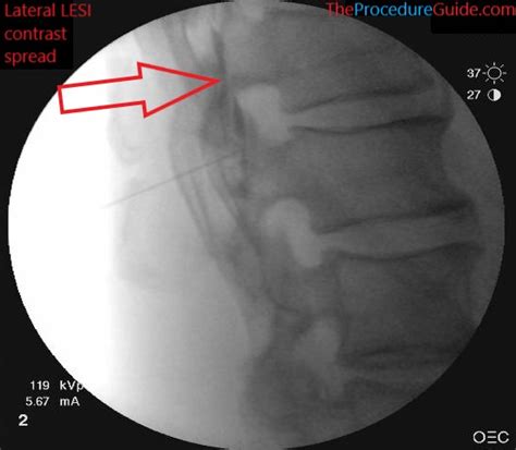 Fluoroscopic Guided Lumbar Medial Branch Block Lmbb Technique And