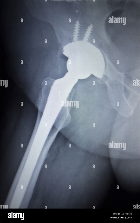 X Ray Scan Image Of Hip Joints With Orthopedic Hip Joint Replacement