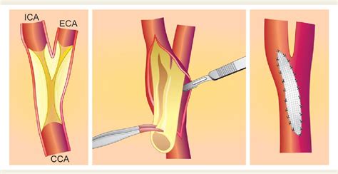 Figure 1 from Carotid artery stenting vs. endarterectomy. | Semantic ...