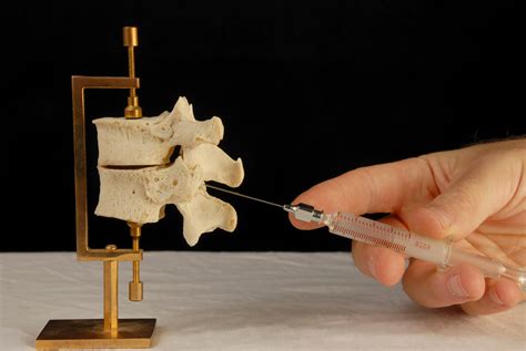 Lumbar Radiofrequency Neurotomy Procedure For Pain Cpmc