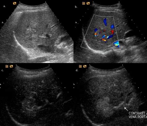 Wk 2 Liver Pathology Ig 12 12 A B Mode Image Shows Ill Defined