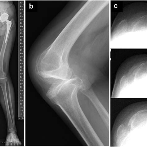 Preoperative radiographs demonstrating bilateral severe valgus knee... | Download Scientific Diagram