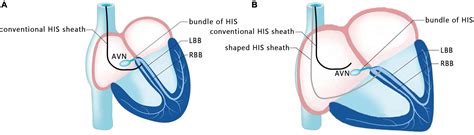 Frontiers Left Bundle Branch Area Pacing In A Giant Atrium With