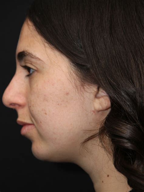 Patient Chin Implants C Solomon Facial Plastic