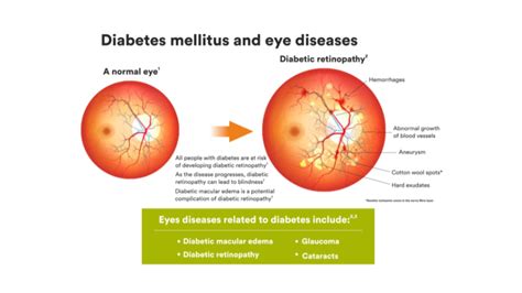 Diabetic Macular Edema Causes Symptoms Treatment Options