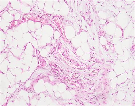 Based On The Histomorphological Findings Fibrin Thrombi Were Noted In