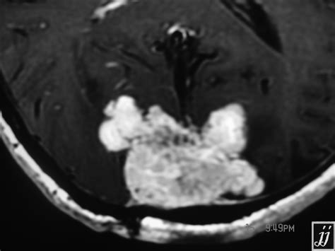 What Size Brain Tumor Is Considered Large Mri Tumor Classification