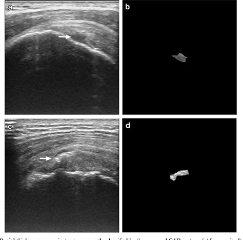 Figure 3 From Computer Aided Diagnosis Of Different Rotator Cuff Lesions Using Shoulder