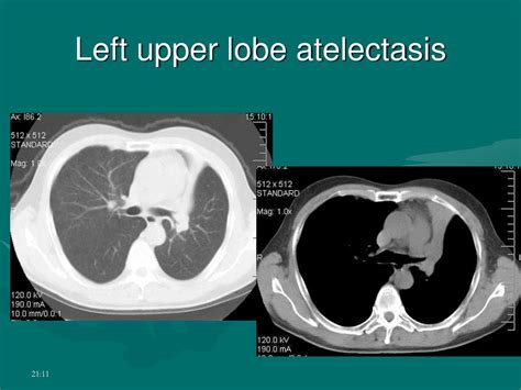 Imaging Pattern Of Respiratory Disease Ppt Download