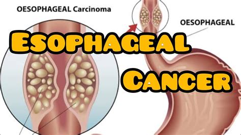 Esophageal Cancer Types Risk Factors Pathogenesis Signs And Symptoms Diagnosis Treatment