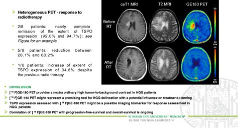 Tspo Pet Imaging Of High Grade Glioma Hgg Using The Novel Ligand