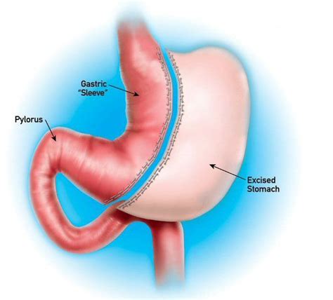 Chirurgia Bariatrica Tipologie Di Interventi Prezzi E Recensioni