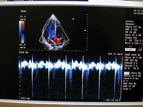 ¿qué Es Un Ecocardiograma ¿y Un Doppler Unidad Médica