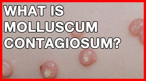 What Is Molluscum Contagiosum And Warts Signs Symptoms And Pictures