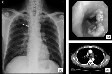 A Chest Radiograph Shows Mediastinal Widening And An Irregular Download Scientific Diagram