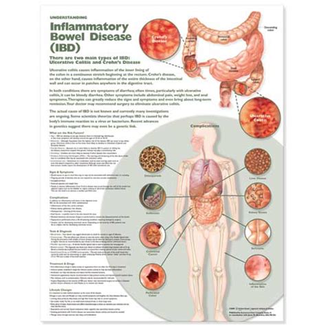 Understanding Inflammatory Bowel Disease Ibd Anatomical Chart Soft