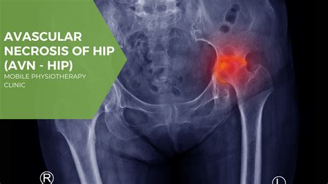 Avascular necrosis of Hip (Avn-Hip): Cause, Symptoms, Treatment | Mobile