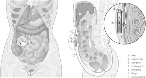 Legend Illustration Of The Implantable Pump In Situ Derived From 9 Download Scientific