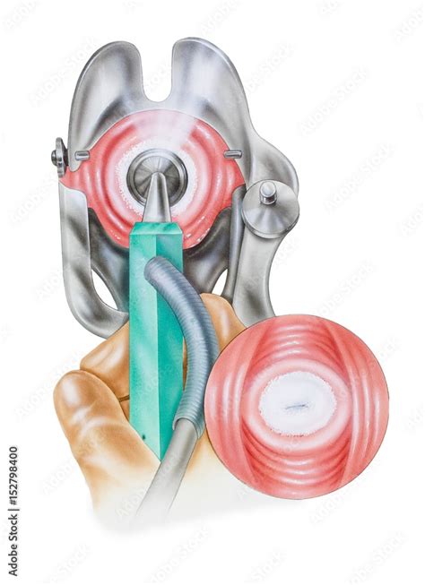 Cryosurgery to remove cervical lesions. Shown are the procedure (top ...