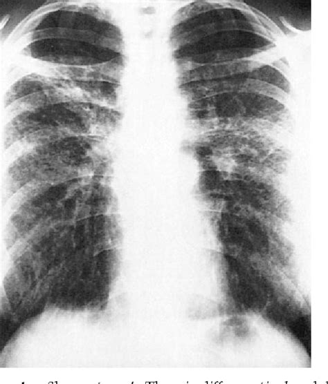 Sarcoidosis Stages Chest X Ray SexiezPicz Web Porn