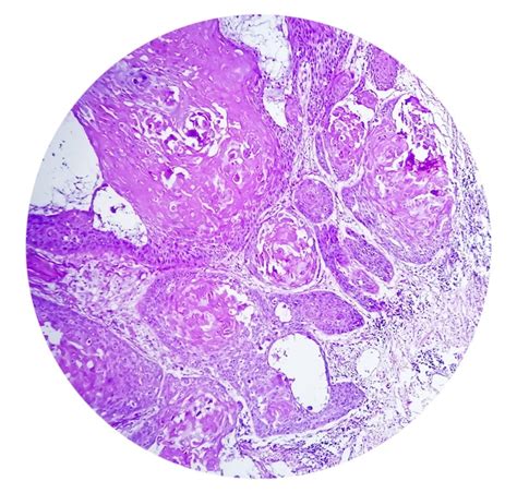 Premium Photo Photomicrograph Of Invasive Squamous Cell Carcinoma Of