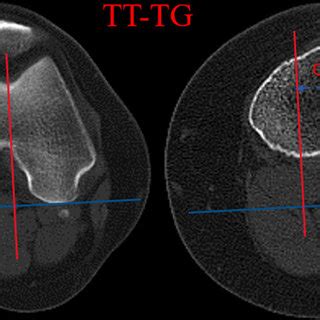 Kra Defined As The Angle Between The Femoral Posterior Condylar Line