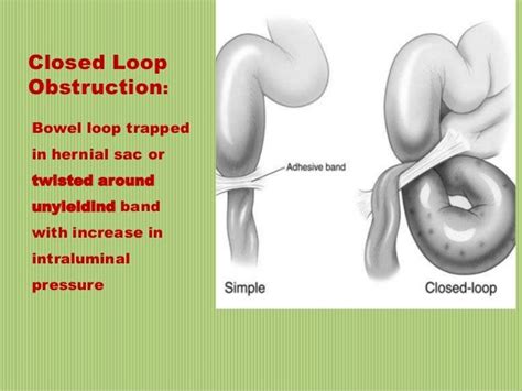 Diagnosis And Managment Of Intestinal Obstruction By Dr Moh Hazem El…