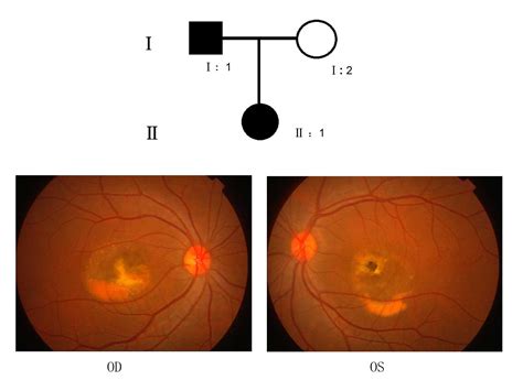 Vitelliform Macular Dystrophy