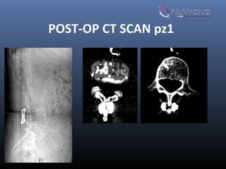 Xlif Ilif Circumferential Arthrodesis As A Minimally Invasive Ppt