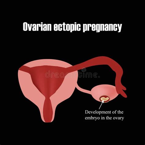 Desenvolvimento Do Embrião No Ovário Gravidez Ectópica Infographics