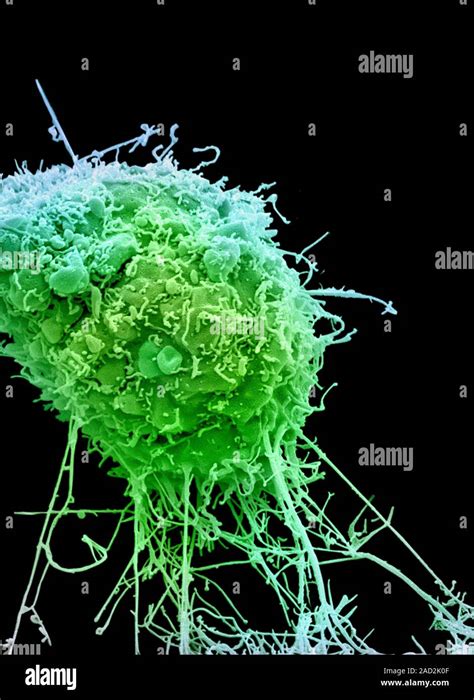 Cervical Cancer Cell Coloured Scanning Electron Micrograph Sem Of A