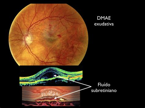 Cómo se diagnostica la degeneración macular exudativa Clínica Villoria