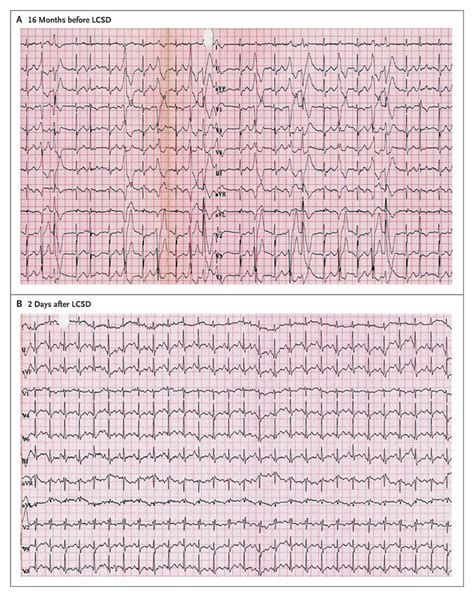 Left Cardiac Sympathetic Denervation For Catecholaminergic Polymorphic