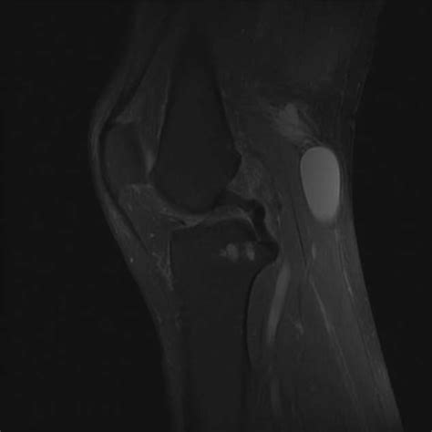 MRI Of The Knee Showing A Popliteal Cyst Marked By The White Arrow