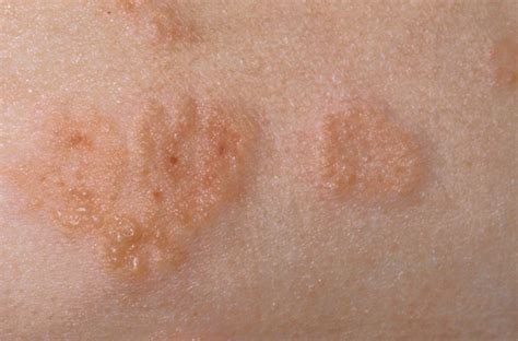 Itchy Skin Pruritus Causes Treatment And Home Remedies 52 Off