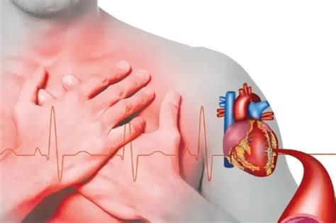 Causas Y Consecuencias De Un Infarto Al Miocardio Horizonte De Matamoros