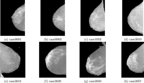 Set of digital mammograms. | Download Scientific Diagram