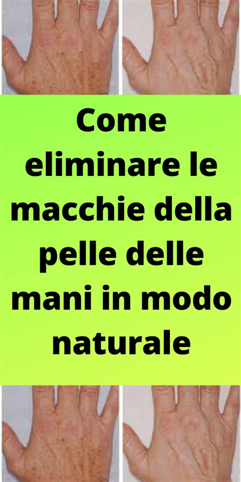 Come Eliminare Le Macchie Della Pelle Delle Mani In Modo Naturale Artofit