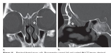 Figure From Failed Endoscopic Sinus Surgery Spectrum Of Ct Findings