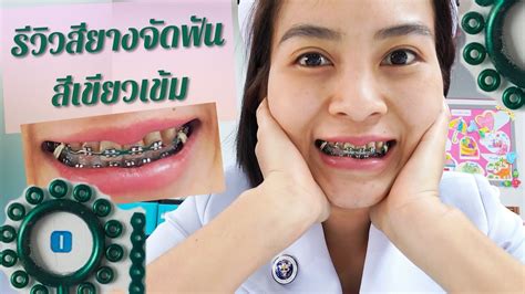 รีวิวสียางจัดฟัน เชนสีเขียวเข้ม คุยเฟื่องเรื่องจัดฟัน Ep35 Youtube