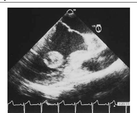 Figure From Cardiac Hemangioma In The Left Ventricle And Brief Review