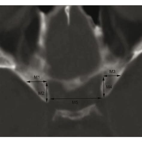 Pneumatisation Of The Left Anterior Clinoid Process Acp Download Scientific Diagram