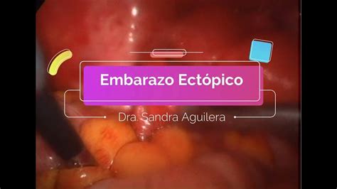 Manejo Laparoscópico de Embarazo ectópico Dra Sandra Aguilera