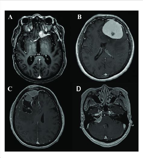 A Axial T1 Post Contrast Mri Demonstrating An Anterior Clinoid