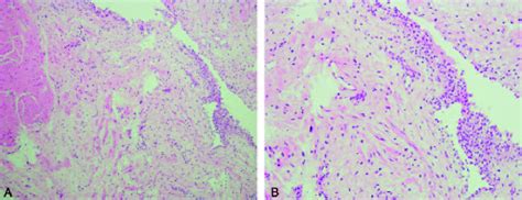 A, Bladder biopsy (100 Â). Regeneration of the urothelium was seen ...